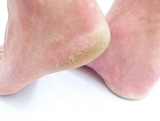 Jak sobie radzić ze suchą skórą nóg?